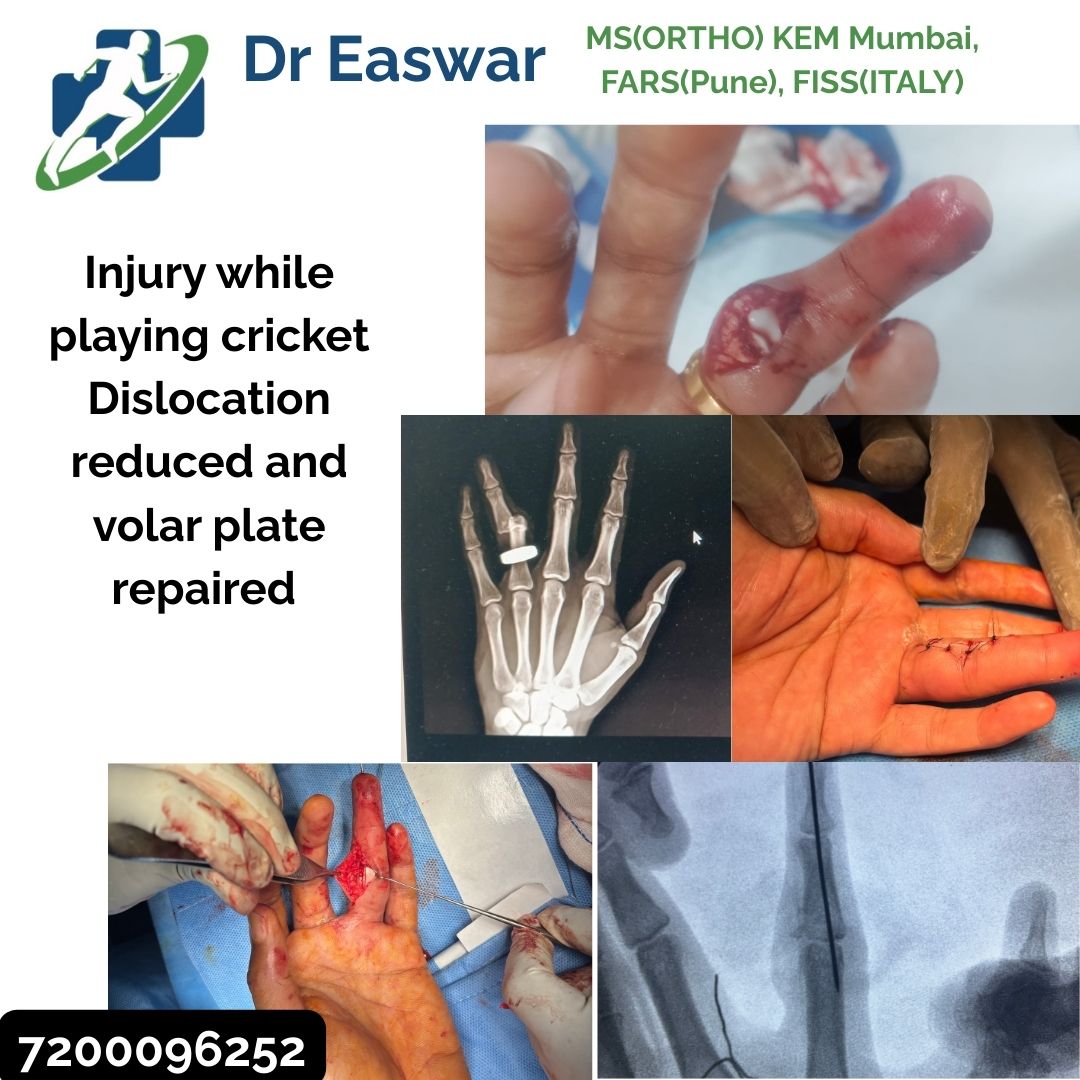 Cricket Ball injury leading to open fracture managed immediately